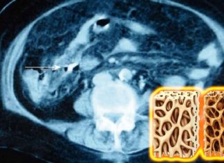 Certain type of sugar water be medicine for perforated bones