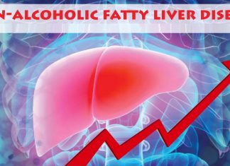 Non-alcoholic fatty liver disease is often caused by obesity and affects nearly 25 percent of U.S. and European adults