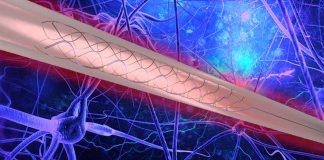 A tiny neural implant dubbed the Stentrode allows people with upper limb paralysis to regain motor function