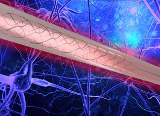 A tiny neural implant dubbed the Stentrode allows people with upper limb paralysis to regain motor function
