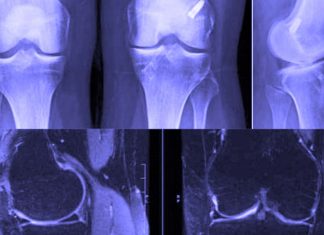 An injury to the anterior cruciate ligament (ACL) can lead to severe osteoarthritis