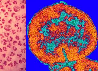 New eye drop containing natural antimicrobial agent can treat antibiotic resistant gonococcal blindness