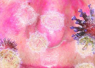 In severe cases of COVID-19 B cell activation is looking similar to they had observed in systemic lupus erythematosus (SLE)