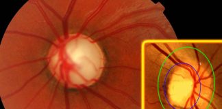 CLINICAL-IMMUNOLOGICAL EFFICIENCY OF OZONE THERAPY IN THE COMPLEX TREATMENT OF PATIENTS WITH PRIMARY OPEN-ANGLE GLAUCOMA
