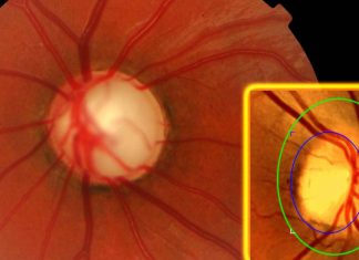 EFFICIENZA CLINICO-IMMUNOLOGICA DELLA TERAPIA CON OZONO NEL TRATTAMENTO COMPLESSO DI PAZIENTI CON GLAUCOMA PRIMARIO AD ANGOLO APERTO