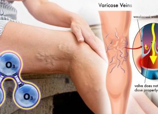 The change of hemostasis system in patients with thrombophlebitis of lower extremities deep veins in ozone therapy