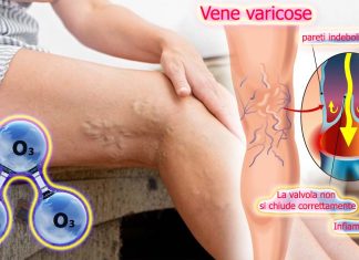Il cambiamento del sistema di emostasi nei pazienti con tromboflebite delle vene profonde degli arti inferiori nell’ozonoterapia