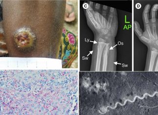 Yaws: Neglected tropical disease is re-emerging