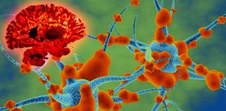 Gut immune cells travel to the brain during multiple sclerosis (MS) flare-ups in patients