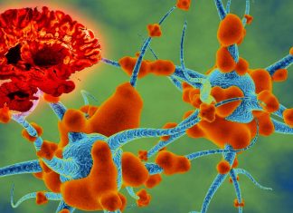 Gut immune cells travel to the brain during multiple sclerosis (MS) flare-ups in patients