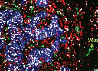 Pro-tumorigenic macrophages contribute to cancer progression