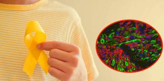 Paroxetina: antidepressivo riproposto per trattare il sarcoma infantile