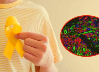 Paroxetina: antidepressivo riproposto per trattare il sarcoma infantile