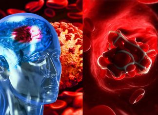 People hospitalized with COVID-19 and neurological problems including stroke have a higher risk of dying