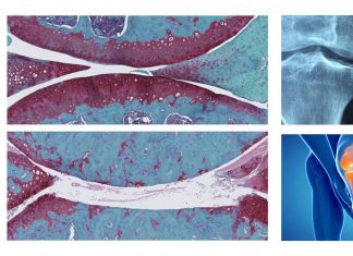 FoxO1 molecule : the gene that protects against osteoarthritis