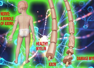 No link between COVID-19 and Guillain-Barré syndrome