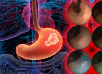 Stomach cancers may respond to medicines that inhibit TNF