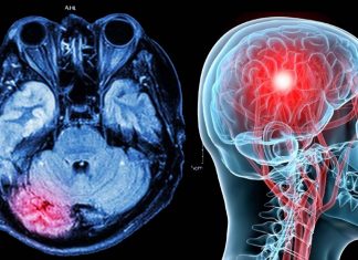 Vestibular agnosia: new neurological diagnosis following a TBI