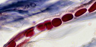 A new endovascular technology can explore capillaries