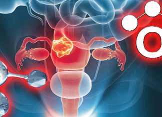 Influenza dell’ozono terapia sulla sensibilità delle cellule del cancro cervicale alla terapia chimica e radiologica