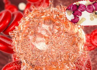 Acute myeloid leukemia (AML): MDM2 inhibitors and BET inhibitors work synergistically to promote significant anti-leukemia activity