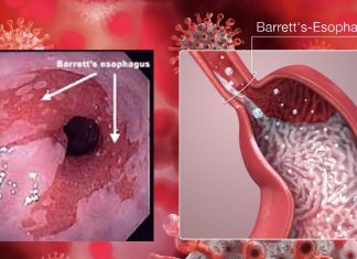 COVID-19: le persone con problemi nel tratto gastrointestinale superiore (GI) possono essere vulnerabili alle infezioni dopo aver ingerito il virus