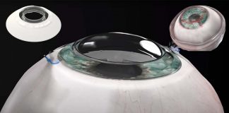 CorNeat: the new artificial corneal implant that integrates directly into the eye wall