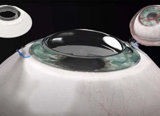 CorNeat: the new artificial corneal implant that integrates directly into the eye wall