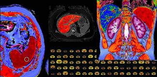 Perspectum’s CoverScan MD technology enables healthcare providers to identify Coronavirus-related systemic organ damage