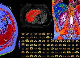 Perspectum’s CoverScan MD technology enables healthcare providers to identify Coronavirus-related systemic organ damage