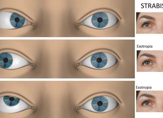 Strabismus does not impair a person’s ability to perceive 3-D layout