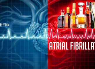 Alcohol has an immediate effect on the heart in patients with atrial fibrillation (AFib)