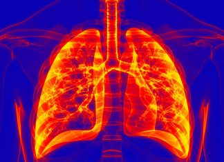 Cases of acute respiratory distress syndrome (ARDS) have skyrocketed because of the ongoing COVID-19 pandemic