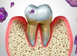 Gum disease: how does P. gingivalis colonize the mouth?