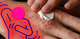 Gli allergeni nell’ambiente sono spesso responsabili di episodi di prurito acuto nei pazienti con eczema
