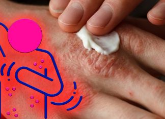 Gli allergeni nell’ambiente sono spesso responsabili di episodi di prurito acuto nei pazienti con eczema