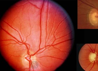 Novel low molecular weight dextran-sulphate (ILB) could play a key role in treating open angle glaucoma (OAG)