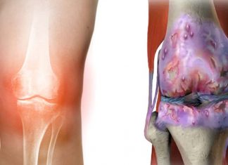 Osteoarthritis: simple knee injection could potentially stop the disease’s effects