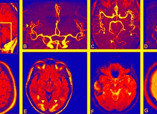 Adults who smoke are more likely to experience a serious type of subarachnoid hemorrhage (SAH)