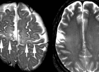 Hypoxia activates the growth factor erythropoietin (Epo) in the brain