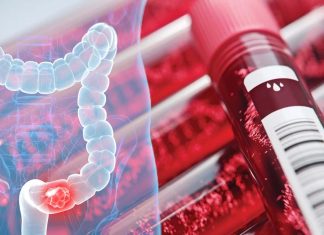 Liquid biopsy for colorectal cancer could detect tumor DNA in the blood and urine