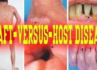 Single strain of bacteria may be able to reduce the severity of graft-versus-host disease (GVHD)