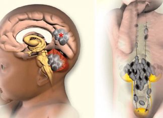 All neuroblastomas arise from a single type of embryonic cell called sympathoblasts