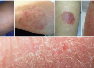 Atopic dermatitis (AD): protein called p62 influences the inflammatory changes in diseased epidermis