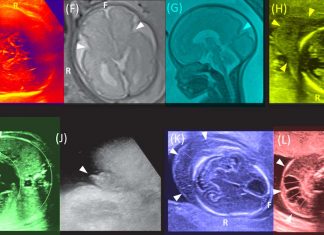 MRI imaging is more adept at detecting fetal abnormalities than conventional ultrasound imaging