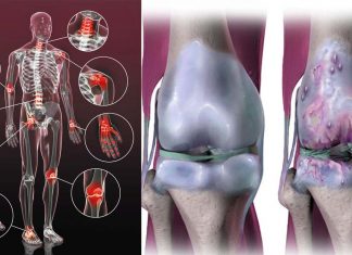 Osteoarthritis: interleukin is the source of harmful feed-forward loop that leads to more breakdown of the cartilage
