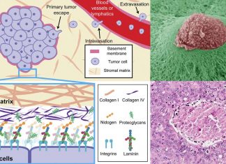 Tumors: the protective basement membrane may be key to preventing metastasis
