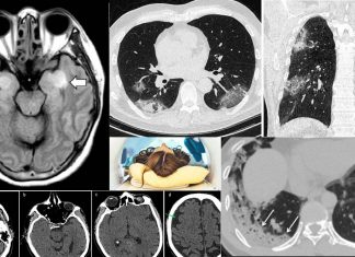 COVID-19: la TC polmonare può predire altri problemi neurologici che potrebbero presentarsi alla risonanza magnetica cerebrale
