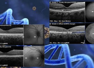 GUCY2D Gene therapy improve some aspects of vision in patients with childhood blindness