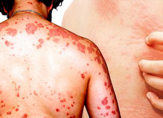 Cysteine leukotriene receptor 2 appears to be a key player in chronic itch